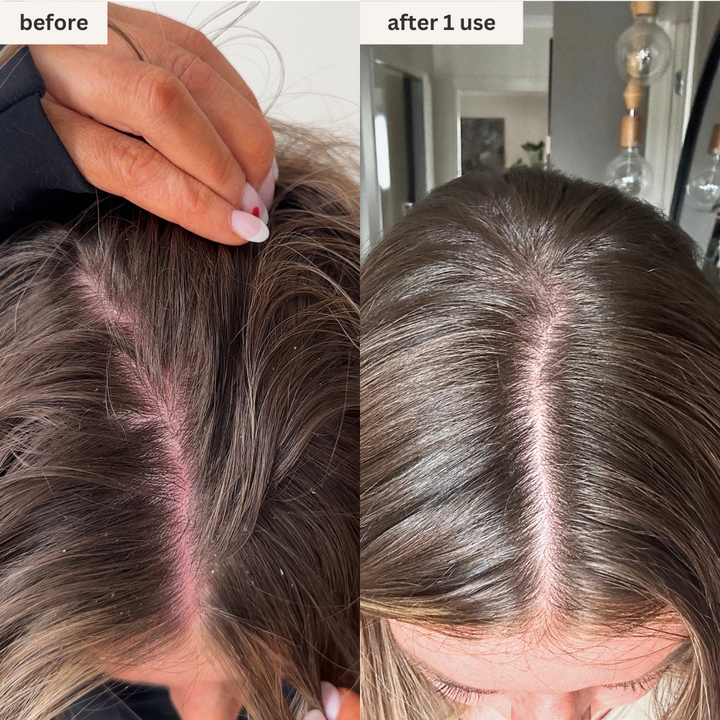 Before and after results of scalp treatment using OVEV Wellness Oceanic Renewal Hair Masque, showing improved scalp health and reduced dryness after one use.