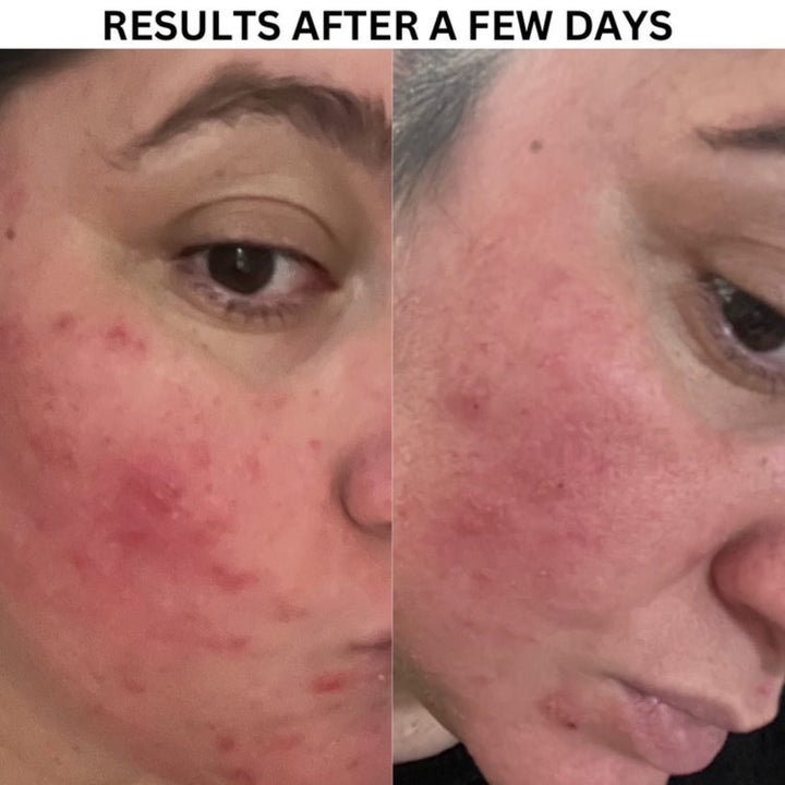 Before and after photos of a woman's face showing clear skin improvement from an exfoliating facial treatment. The left image displays visible redness and blemishes, while the right image shows a smoother, clearer complexion.