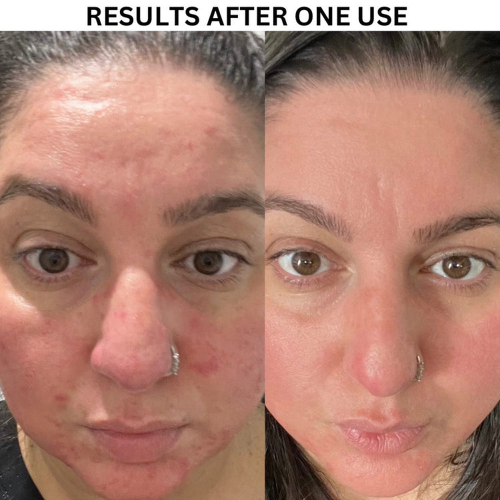 Before and after photos of a woman's face showing clear skin improvement from an exfoliating facial treatment. The left image displays visible redness and blemishes, while the right image shows a smoother, clearer complexion.