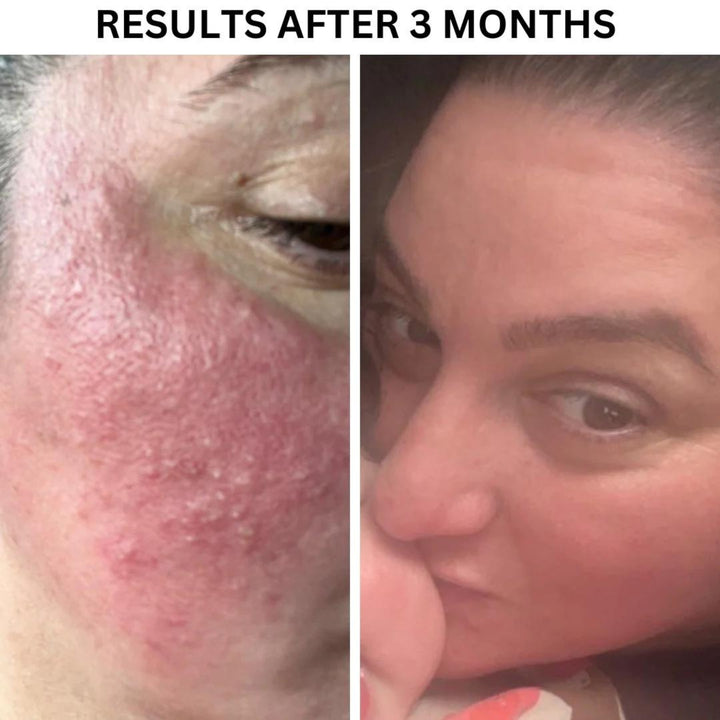 Before and after photos of a woman's face showing clear skin improvement from an exfoliating facial treatment. The left image displays visible redness and blemishes, while the right image shows a smoother, clearer complexion.