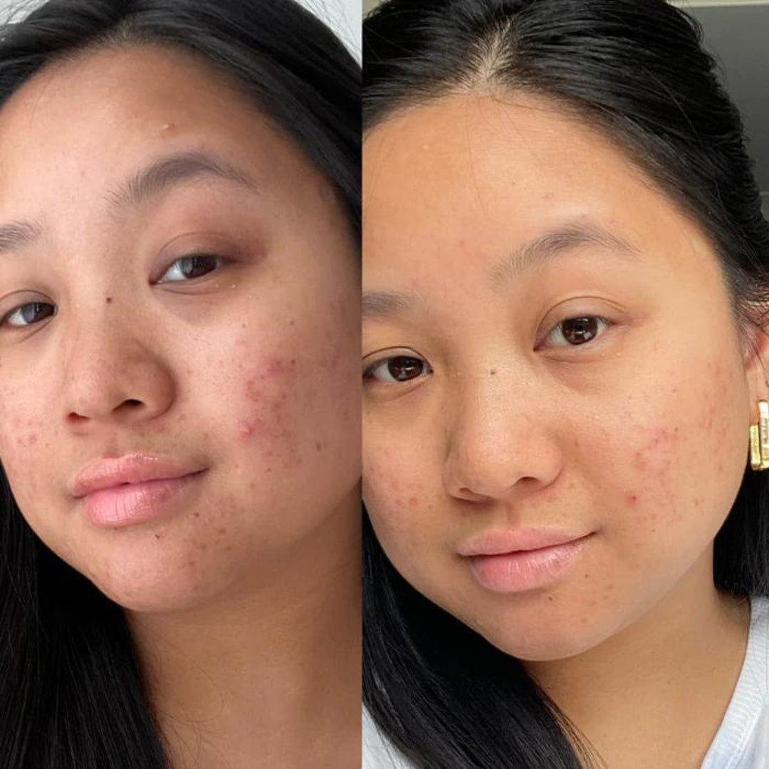 A split-image showing the before and after results on a woman's face from a skincare regimen. The left side of the image shows her face with visible acne and blemishes. The right side, after acne clearing gel usage, shows her skin with a noticeable reduction in blemishes and a smoother complexion, indicating an improvement from the best Australian made face moisturiser.